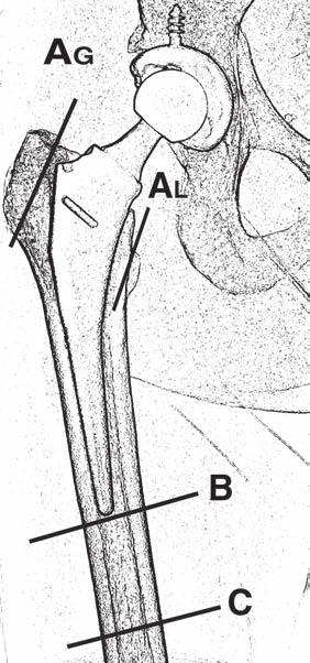 Br 2010; 92:1527 1534 Downloaded from www.ajronline.org by 88.115.10.5 on 04/17/17 from IP addr arthroplasty shows geographic, globular oposterior radiograph of revised right THA with femoral spacer laden with antibiotics (arrow).