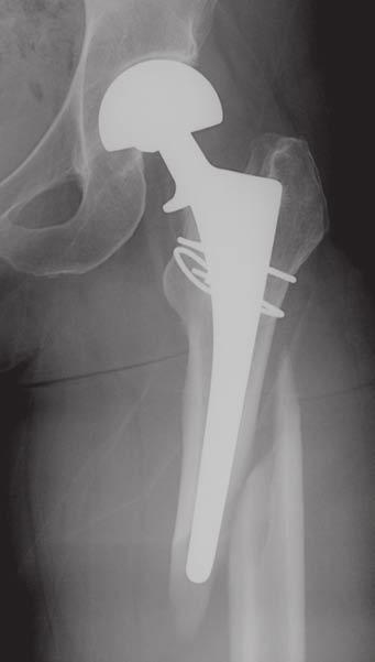 How to image metal-on-metal prostheses elderly patients with displaced femoral neck fraclucency in acetabular zones I and II postoperative anteroposterior radiograph of revised, infected left THA in