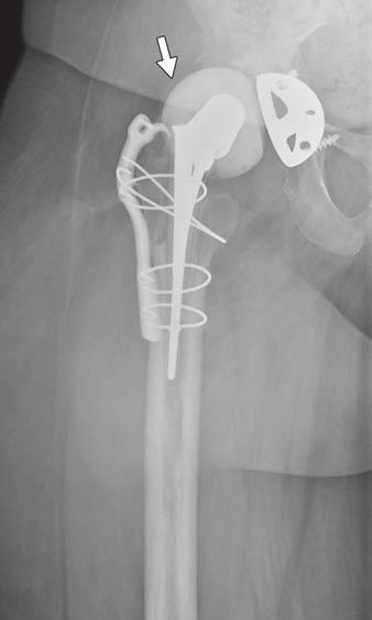 Surrounding cement projects proximal femoralajr bone (arrow). Grammatopoulos G,bone Pandit H, Murray DW,above Gill margins andof their complications.