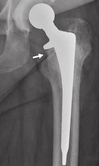 PROSTALAC cup (single arrow),j.extruded cement in (double arrows), HS. The relationship between head-neck and 45.