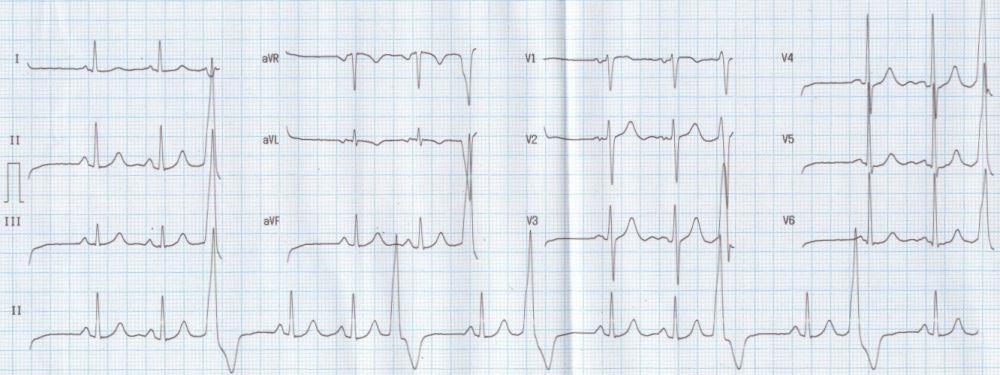 EKG:ssä? 24.