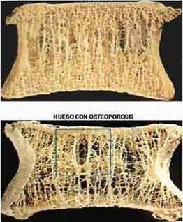 Osteoporoosi