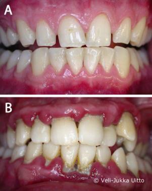 Koko hampaistoon levinneen parodontiitin pinta-ala 20 cm² (Hujoel PP, White BA, Garcìa RI, ym. The dentogingival epithelial surface area revisited. Periodontal Res 2001; 36:48-55.