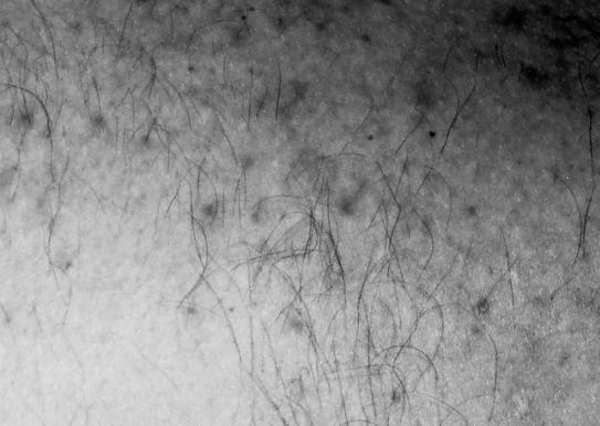 potilaista pitkittyä (Kurkela, J Infect Dis 2005) 3 vuoden seurannassa 25%:lla oireita, 14%:lla selkeitä artiriitti-, artralgialöydöksiä (arkuus, turvotus) (Kurkela, Scand J Infect Dis 2008)
