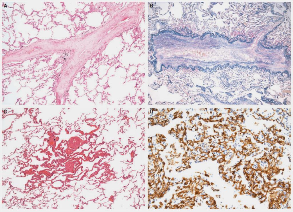 Pulmonary occlusive venopathy CD34 Pulmonary