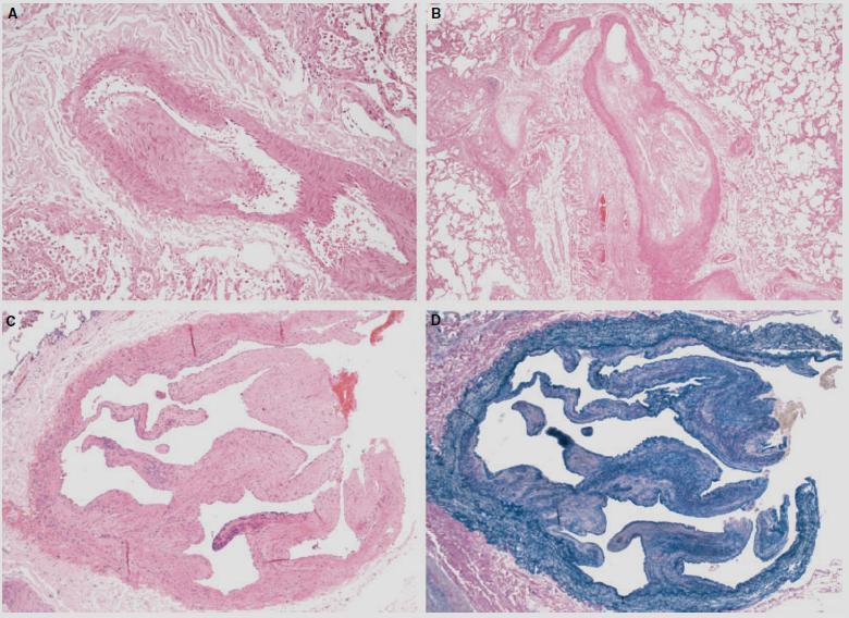 Chronic tromboembolic pulmonary hypertension Eccentric intimal thickening Luminal