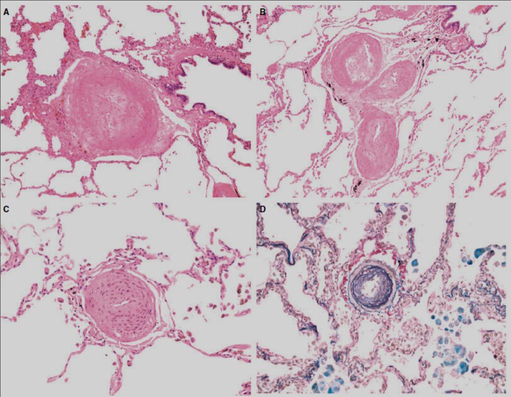 Stewart et Rassl, Histopathology 2009, 54, 104-116 Pulmonary arteriopathy Medial