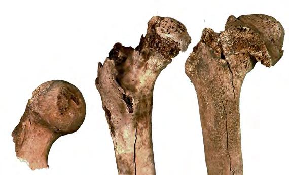 OSTEOLOGISIA TUTKIMUKSIA Kuva 34. Lonkkanivelen osteoartroosin eli nivelkuluman eri vakavuusasteita. Vakavin kuluma oikealla. muutoksia on joskus käytetty myös yhteisön elintason osoittimena.