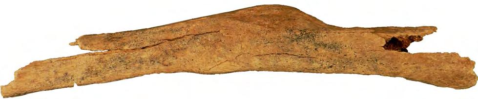 OSTEOLOGISIA TUTKIMUKSIA Kuva 36. Väärään asentoon luutunut parantunut murtuma sääriluussa.