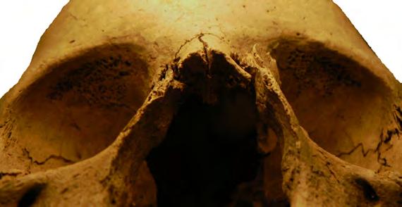 OSTEOLOGISIA TUTKIMUKSIA Kuva 39. Cribra orbitalia eli silmäkuoppien yläosan reikäisyyttä. seen Porvoon kirkkomaan aineistoon, 28 ovat ne kuitenkin kovin vähäisiä.