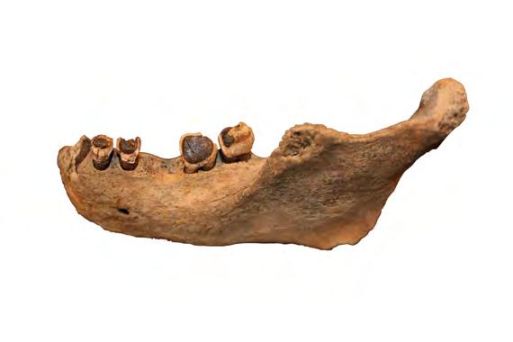 OSTEOLOGISIA TUTKIMUKSIA Kuva 42. Alaleuan vasemman puolen 1. poskihammas menetetty elinaikana. tulehduksessa; syvä karies voi tuhota hampaan, tai se voi murtua jonkin vamman seurauksena.