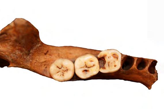 OSTEOLOGISIA TUTKIMUKSIA pitkälle edenneestä infektiosta. 36 Iin Haminan aineistosta karies määriteltiin silmämääräisesti ja ainoastaan selkeä reikiintyminen dokumentoitiin (Kuva 43).