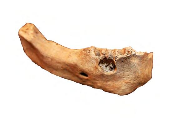 OSTEOLOGISIA TUTKIMUKSIA Tulehduspesäkkeet leukaluussa Monenlaiset absessit ja granuloomat, eli hammasjuurten yhteyteen syntyvät märkäpesäkkeet ja tulehdussolukertymät, ovat arkeologisessa