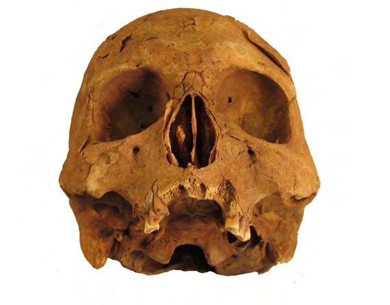 OSTEOLOGISIA TUTKIMUKSIA Kuva 48. Yli 50-vuotiaan miehen luukuopasta löytyneessä kallossa oli piipun polttamisesta kertovaa kuluneisuutta yläleuan kulma- ja välihampaissa.