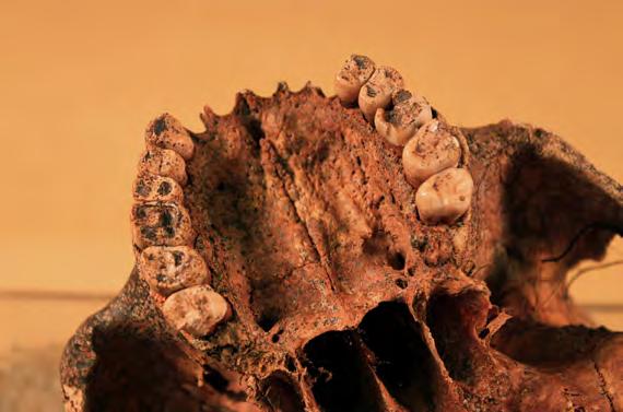 OSTEOLOGISIA TUTKIMUKSIA TORUS PALATINUS SUULAKIVALLI Saaraliina Atkinson Torus palatinus eli suulakivalli on kovan suulaen (kitalaen) keskiviivassa yläleukaluiden ja suulakiluiden yhtymäkohdassa