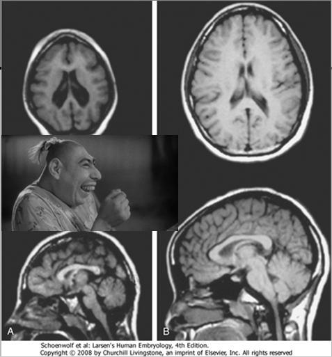 Mikrokefalia ASPM (ABNORMAL SPINDLE-LIKE MICROCEPHALY ASSOCIATED), Drosophilan Abnormal spindle-geenin homologi, on useimmin