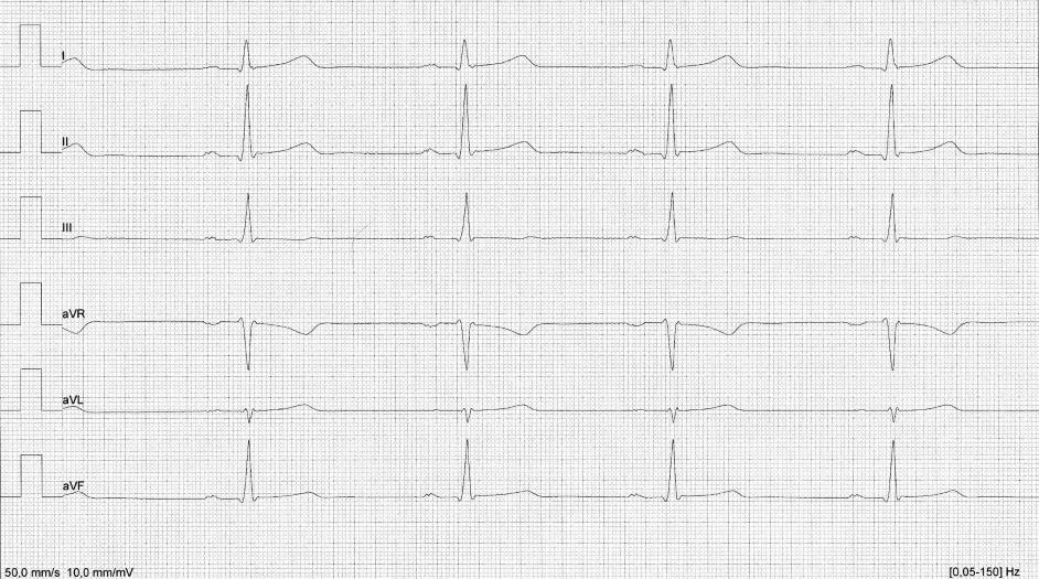 18 2015a.) Valmiissa EKG-käyrässä näkyy paperin nopeus 50 mm/s ja kalibraatio 10 mm/mv (Kuvat 7 ja 8). Kuva 7.