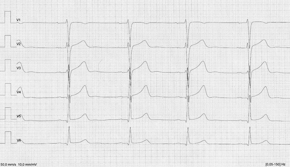 19 Kuva 8. Laadukkaan 12-kytkentäisen EKG-rekisteröinnin raajakytkennät (Kuva: Miia Viljanen) EKG:n lukeminen koostuu kahdesta osasta: EKG-heilahdusten järjestyksen ja muodon tarkastelusta.