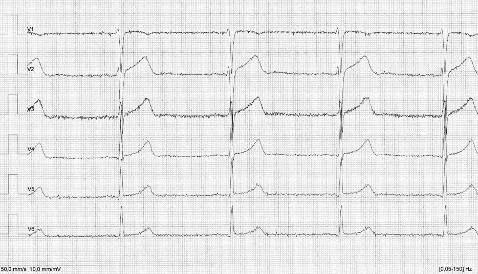 21 3.1 EKG-häiriöt EKG-häiriöitä aiheuttavat potilas, tutkimusympäristö, hoitajan toiminta tai kaikkien näiden tekijöiden yhdistelmä.