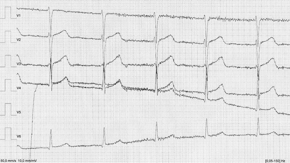 Tällaisia häiriöitä kutsutaan liikehäiriöiksi, koska ei voi sanoa kumpi aiheutti liikehäiriön. EKG-käyrä, jossa on kaksi EKG-häiriötä, on tulkinnan kannalta lähes kelvoton.