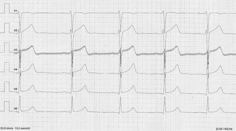 25 3.1.4 Vaihtovirtahäiriö Vaihtovirtahäiriö näkyy EKG-käyrässä sahanterä kuviona (Kuvat 15 ja 16). Sen tunnistaa EKG-käyrästä toistuvasta jännitteen muutoksesta.