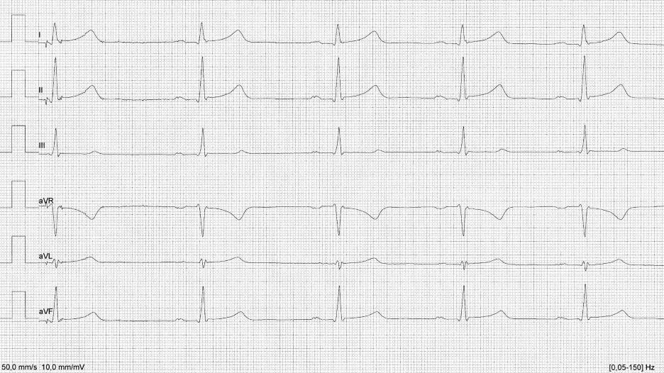 26 Kuva 16. Vaihtovirtahäiriö raajakytkennöissä (Kuva: Miia Viljanen) 3.2 EKG-virheet EKG-käyrän virheet ovat ennalta arvaamattomia, yllättäviä tai ne syntyvät vahingossa.