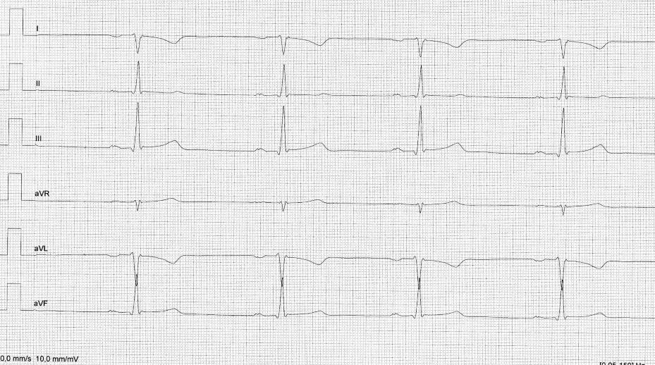 28 Kuva 18. Yläraajakytkennät väärinpäin (Kuva: Kreetta Tilander) Oikean ylä- ja vasemman alaraajan johtimien vaihtumista keskenään on vaikea tunnistaa EKG-käyrästä.