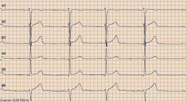 29 Kuva 19. Rintajohtimet väärin (Kuva: Miia Viljanen) 3.2.2 Rintaelektrodien sijoitusvirheet Yleisin EKG-virhe on rintaelektrodien sijoitusvirheet.