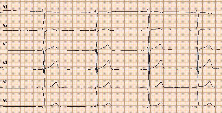 30 Kuva 20. Rintaelektrodit väärissä paikoissa (Kuva: Miia Viljanen) 3.2.3 Kontaktihäiriöt Elektrodin ja johtimen irtoamisen tai muun kontaktihäiriön tunnistaa EKG-käyrään piirtyvästä suorasta viivasta tai siitä, että EKG-laite ei tulosta lainkaan EKG-käyrää.