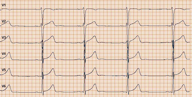 31 Kuva 21. Pastasillan aiheuttama kontaktihäiriö (Kuva: Kreetta Tilander) Matkapuhelin ei yleensä vaikuta EKG-käyrään, mutta joskus niistä saattaa muodostua artefakteja.