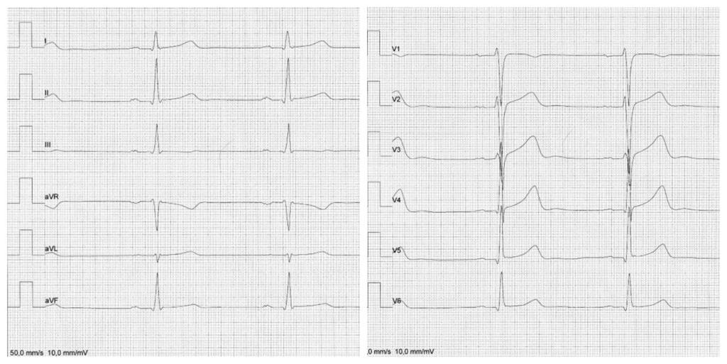 9 Kuva 1. Normaalin EKG:n heilahdukset (Kuva: Miia Viljanen) 2.2 EKG-kytkennät Sydämen sähköistä toimintaa on tarkasteltava eri suunnista.