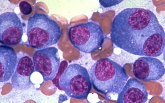 Waldenströmin makroglobulinemia Raskasketjutaudit Myeloomapotilaan luuydinnäyte Lisääntynyt määrä plasmasoluja Infiltraatio voi olla läiskittäinen Immunoglobuliini kaksi raskasta ketjua