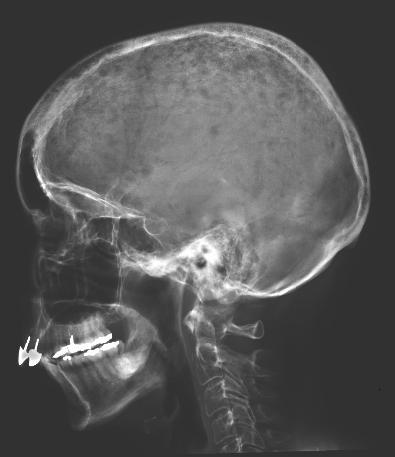 Myelooma Hoitoa vaativa myelooma 1. Monoklonaalisia plasmasoluja Luuytimen aspiraatti > 10% Kasvaimen biopsiassa plasmosytoma 2.