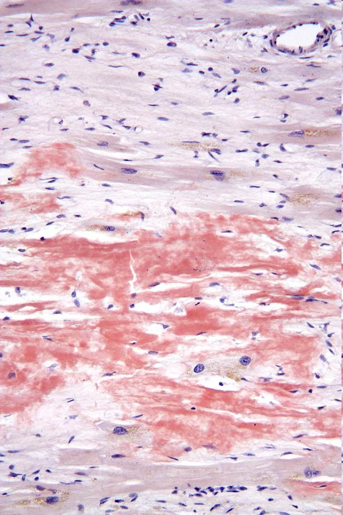 Luuytimessä pienten lymfosyyttien infiltraatti Lymfosyyttien immunofenotyyppi ; pinta-igm, CD5, CD10, CD19, CD20, CD22, CD25, CD27, FMC-7, b-2-mikroglobuliini Häiriintynyt hemostaasi ITP