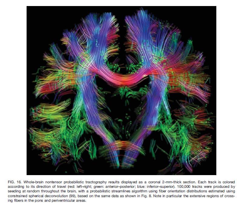 rtms tulevaisuudessa Navigointi välttämätön hoidon toteutuksessa Fysiologisen tiedon ja uuden teknologian hyödyntäminen (PET, fmri, DTI, johtavuuden mallinnus ) A-luokan näyttö masennuksessa ja