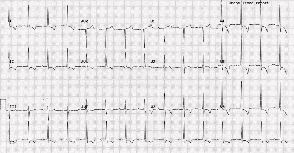 Case 1: chest pain during exercise, 19 yo male Exercise test: