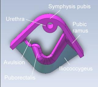 Levator lihaksen obstetrinen trauma Levator voi irrota vaginaalisessa synnytyksessä