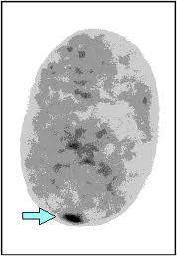 This type of chromatin structure prevents transcription (blue bar below).