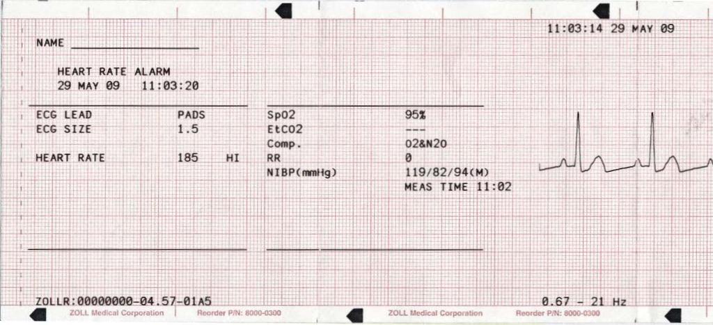 Nauhan yläreunaan tulostuva päivämäärän ja kellonajan merkintä viittaa 6 sekunnin ajalta ennen tapahtumaa oleviin EKG-tietoihin. Kuva 11-5.