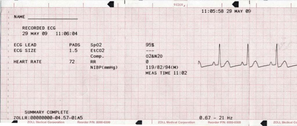 Nauhan yläreunaan tulostuva päivämäärän ja kellonajan merkintä viittaa 6 sekunnin ajalta ennen tapahtumaa oleviin EKG-tietoihin. Kuva 11-7.