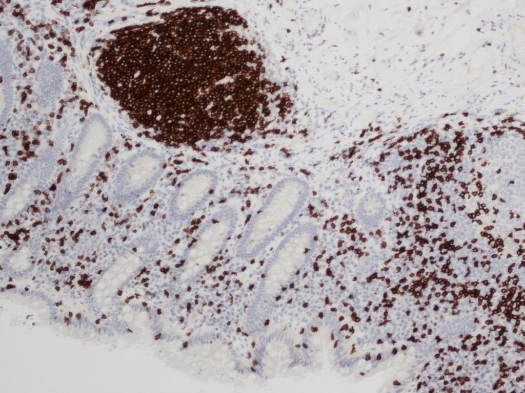 13 Novocastra TM Liquid Mouse Monoclonal Antibody CD3 CD3-antigeenia tavataan T-solujen ulkopinnalla.