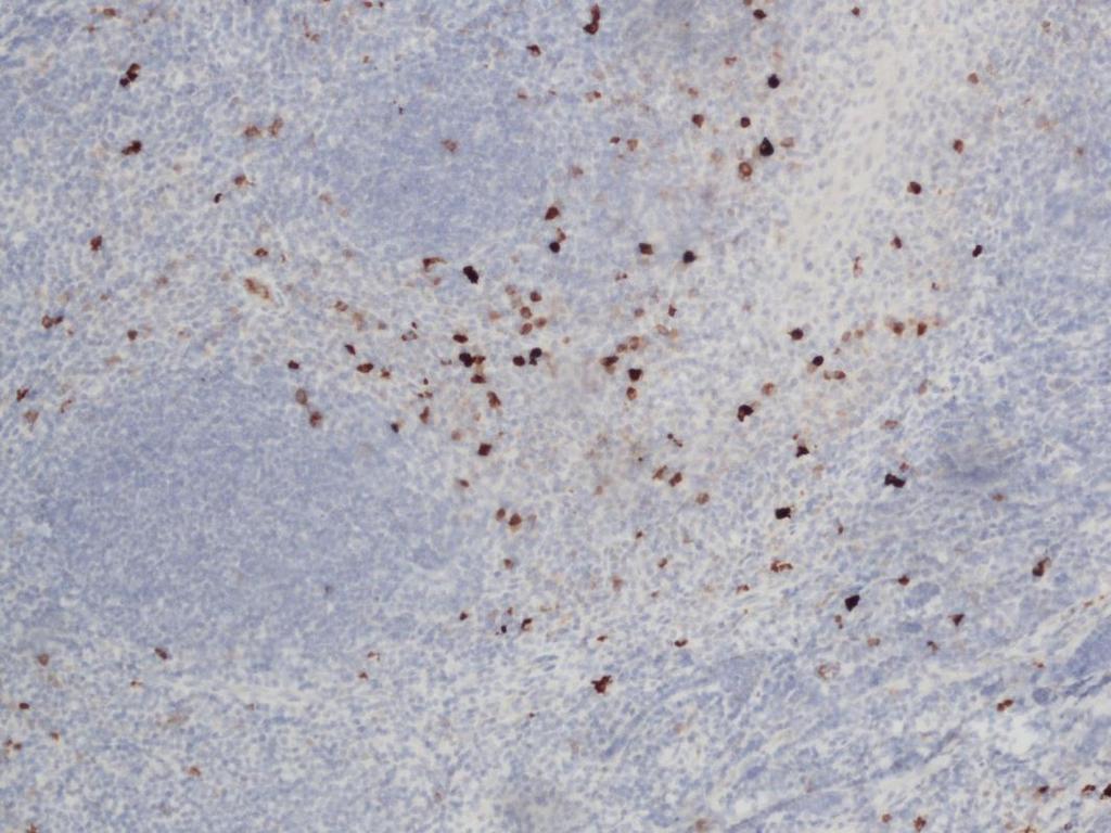 14 Monoclonal Mouse Anti-Human CD30 CD30 on transmembraani sytokiinireseptori, joka kuuluu tuumori nekroosi faktori (TNF) sukuun.