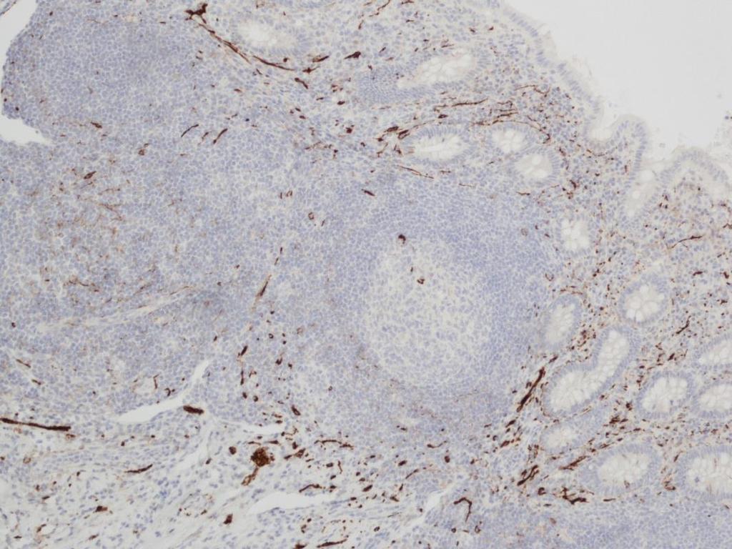 18 Novocastra TM Liquid Mouse Monoclonal Antibody CD56 CD56 on membraanin proteiini, jota ilmenee mm.