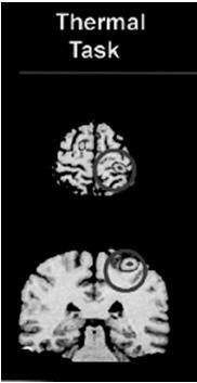 Talamokortikaalinen yhteys Talamuksesta kipuviesti viedään ylöspäin aivokuorelle: Primaarisella