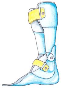 3 2.1.1 AFO ja DAFO AFO (Ankle-Foot-Orthosis) on osittain tai kokonaan nilkan ja jalkaterän ylittävä ortoosi. AFOt valmistetaan usein polypropyleeni-muovista.