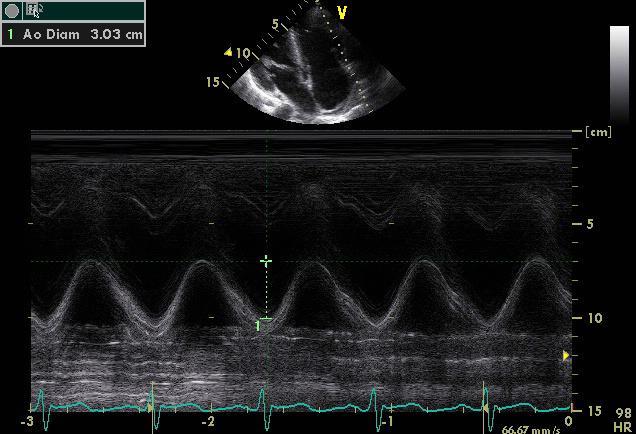 RV-funktio TAPSE (tricuspid annular