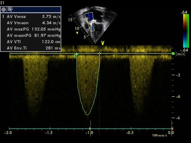 huippugradientti yli 64mmHg