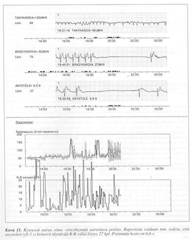 Vuosi elämästä Lisälyönnit 24h EKG synkopee FA VES 0 vrk 365 Karkeasti: Alle 60-vuotiaalla yleensä normaalisti <100 eteislisälyöntiä <100 kammiolisälyöntiä Yli 60 vuotiaalla yleensä normaalisti <1000