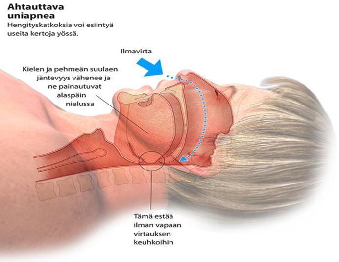 Uniapnea pähkinänkuoressa Obstruktiivinen uniapnea: Nukkuessa tapahtuvat toistuvat, vähintään kymmenen sekunnin mittaiset hengityskatkokset tai hengityksen vaimentumat, jotka johtuvat