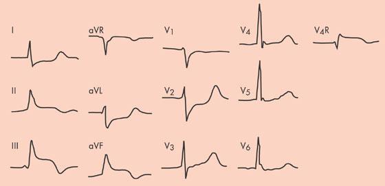 mittaushäiriö Mikä ilmiö EKG:ssa on? Valitse oikea vaihtoehto.